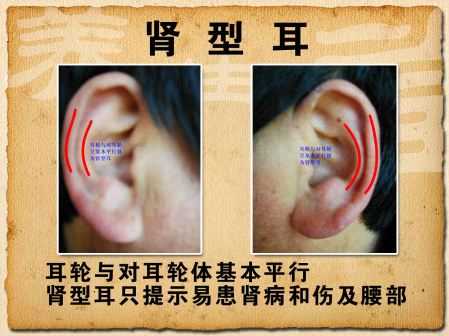 耳诊肾型耳