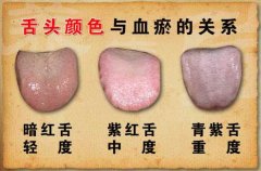 舌头颜色与血瘀的关系图片