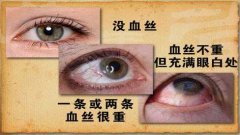 <b>20130218养生堂视频和笔记:王宏宇讲血管老化,眼底出血,血丝,食疗</b>