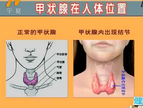 甲状腺在人体的位置
