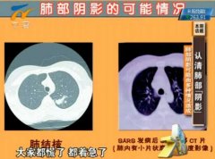 20130513健康大财富视频和笔记:纪小龙讲肺部阴影,结核病,肺癌