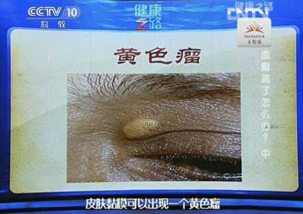 黄色瘤