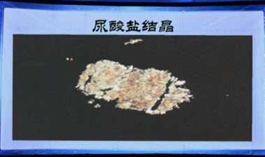 尿酸盐结晶图片