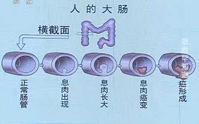 大肠癌