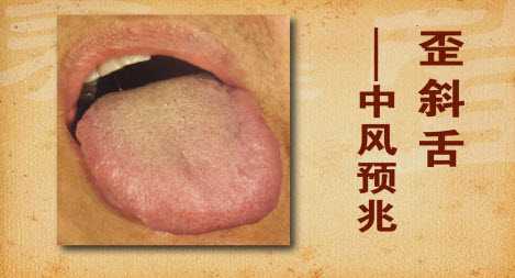 舌头伸出歪斜,就往往预示着健康出现了问题