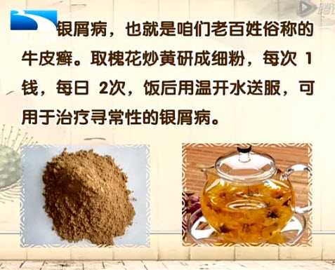 槐花治疗银屑病（牛皮癣）
