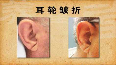耳垂皱折