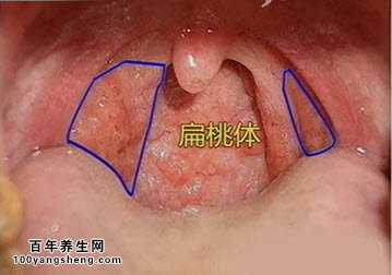 急性化脓性扁桃体炎危害较大