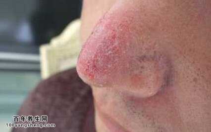 红鼻子是为什么