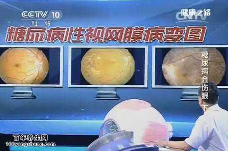 早期糖尿病性视网膜病变能治好