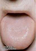 舌头表面的变化和健康：舌头的胖瘦，镜面舌，淤血停积，舌生芒刺