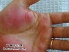 手掌发红是什么原因？手掌发红可能是高血压的早期症状