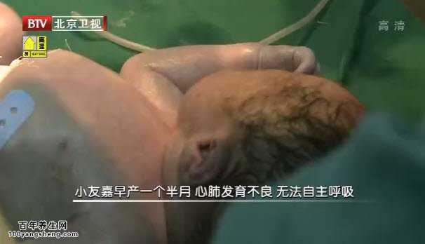 早产婴儿没有呼吸