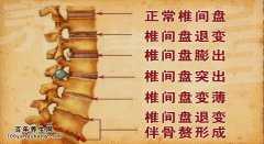 20140814养生堂视频和笔记:刘忠军讲腰疼的原因有哪些,腰椎盘突出