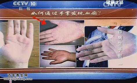 正常人的手是白里透红的颜色，如果有人手出现暗紫色提示血瘀情况