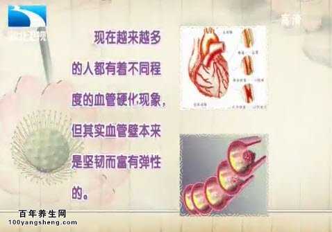 什么是动脉粥样硬化