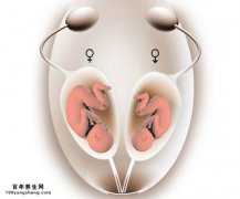 <b>双子宫双阴道产双胞胎,试管婴儿助其圆梦</b>