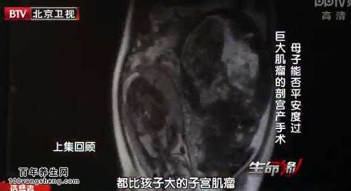 胎盘早剥