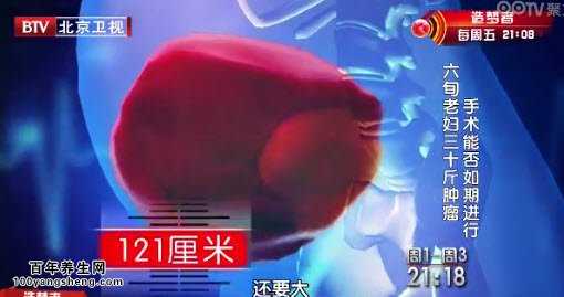 脂肪肉瘤