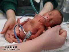 新生儿呼吸困难综合征怎么办？