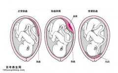 可能导致前置胎盘的因素及类型, 前置胎盘的处理