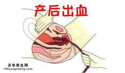 产后出血