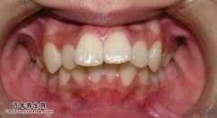 错牙畸形的原因,该如何预防错牙畸形？