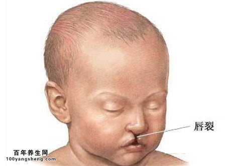 唇腭裂