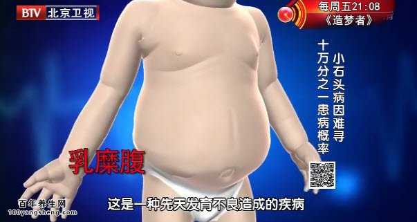 乳糜腹