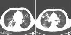 肺脓肿的治疗及预防