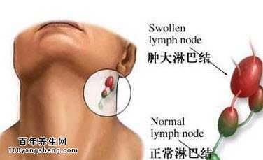 颈部淋巴结核的临床症状有哪些及经络穴位诊断