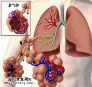 肺气肿的临床症状有哪些及经络穴位诊断