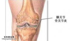 膝骨性关节炎图片