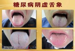 糖尿病舌相图片