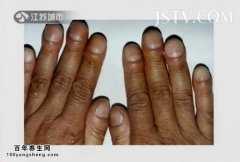 20150720万家灯火视频和笔记:韦云,扳机指,杵状指,手指形状