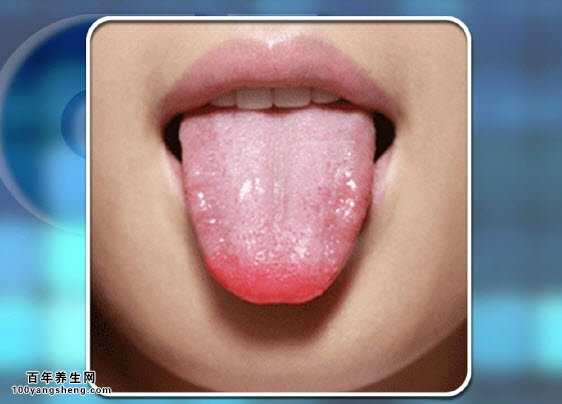 心火旺的表现