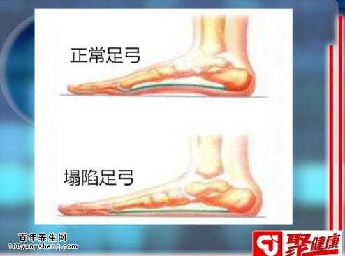 如何避免足弓塌陷