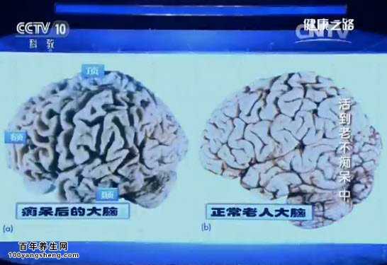 脑萎缩