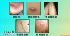 20151209X诊所视频和笔记:刘天一,疤痕,耳软骨炎,疤痕类型的预防