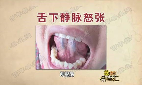 静脉怒张