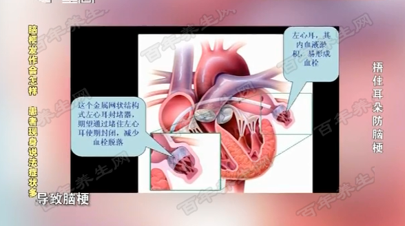 左心耳封堵术