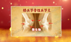 膝关节骨性关节炎图片