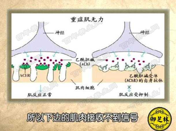 重症肌无力