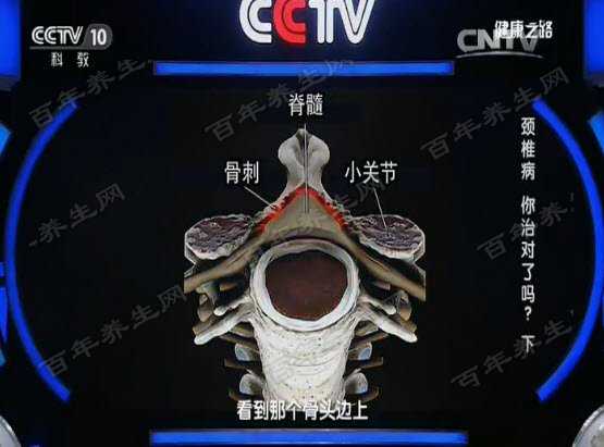 颈椎管狭窄是如何形成的