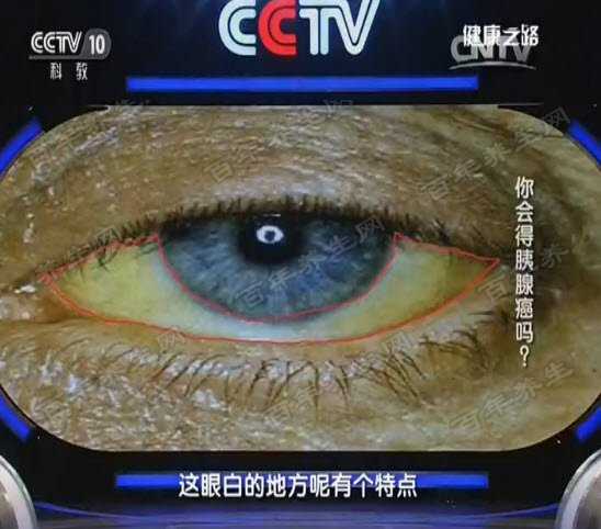 眼白发黄