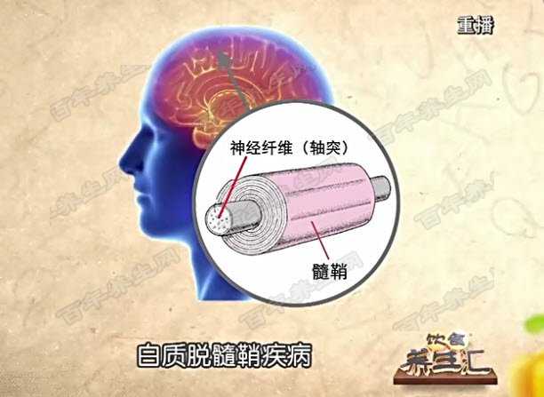 多发性硬化症