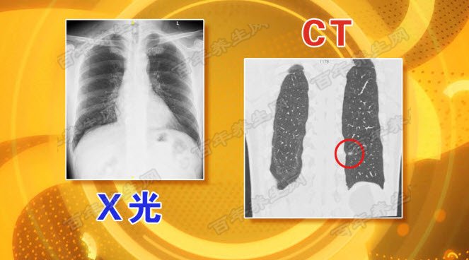 X光片与CT的区别