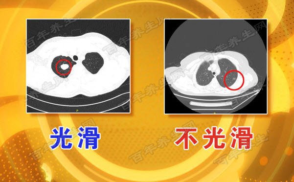 肺部结节光滑与不光滑