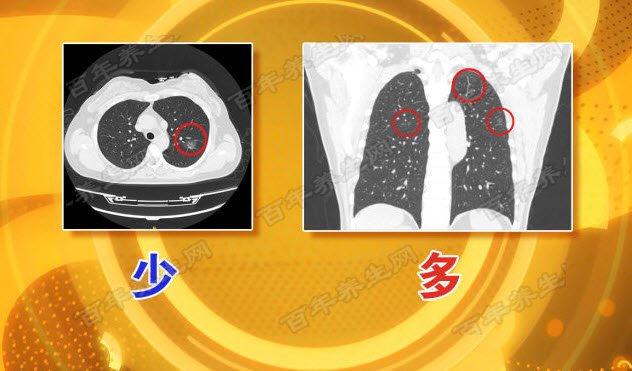 20160702养生堂视频和笔记:李单青,肺癌,肺癌