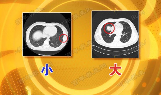 肺部结节大与小